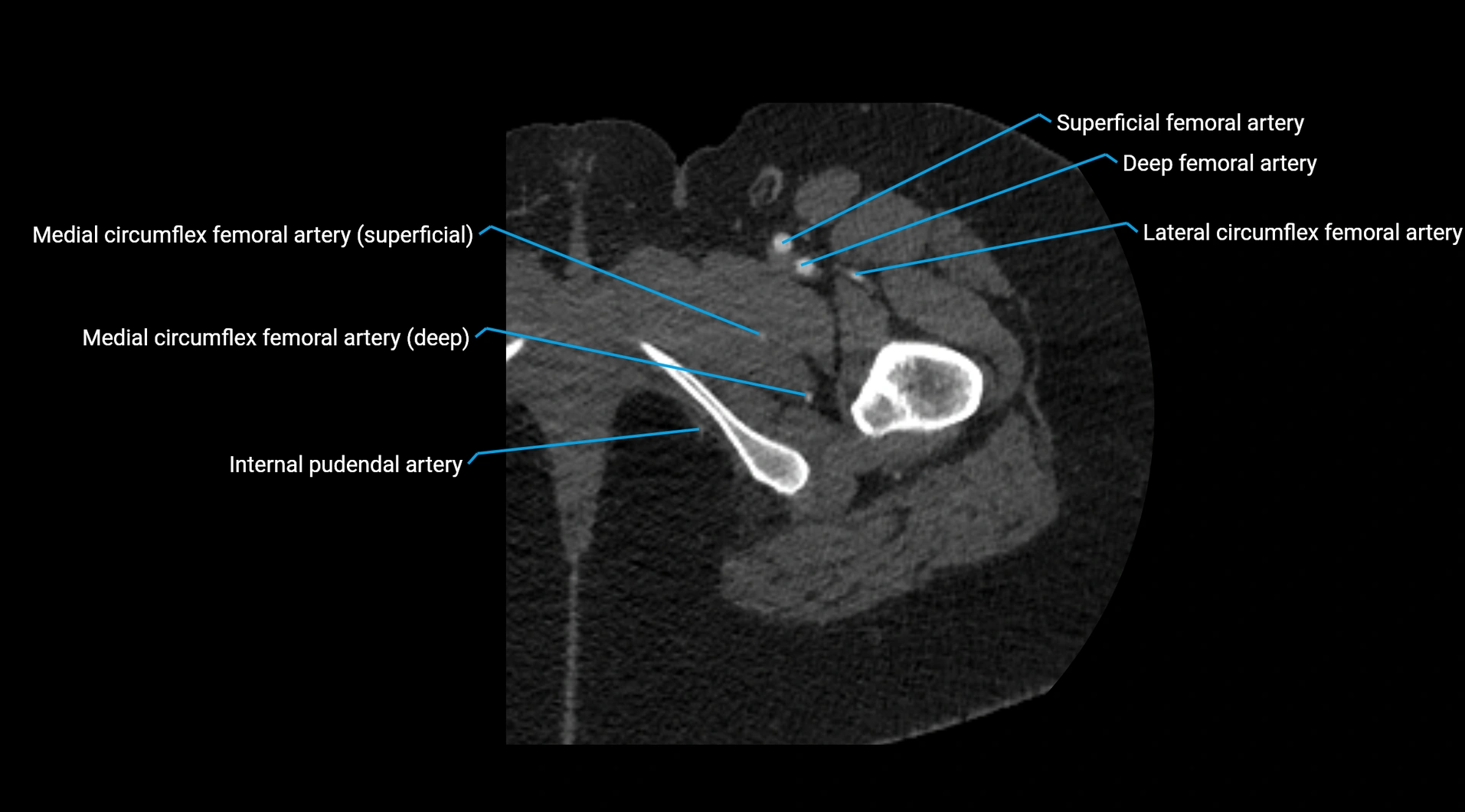 CTA lower limb cross sectional anatomy labelled image _73.webp